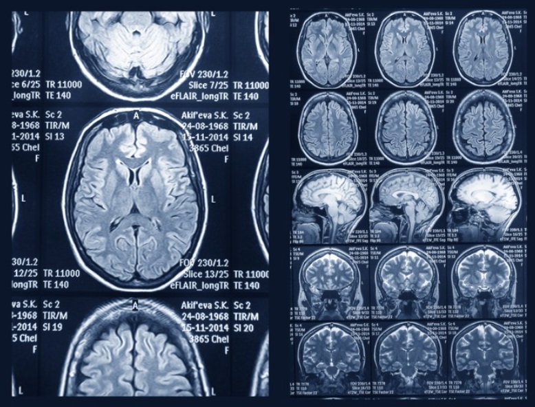 CT Scans